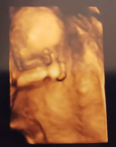 3D Ultrasound of Dale and Joseph's baby girl